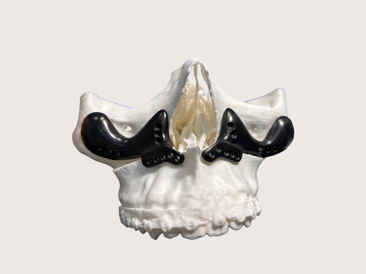 Caso maxilofacial 1