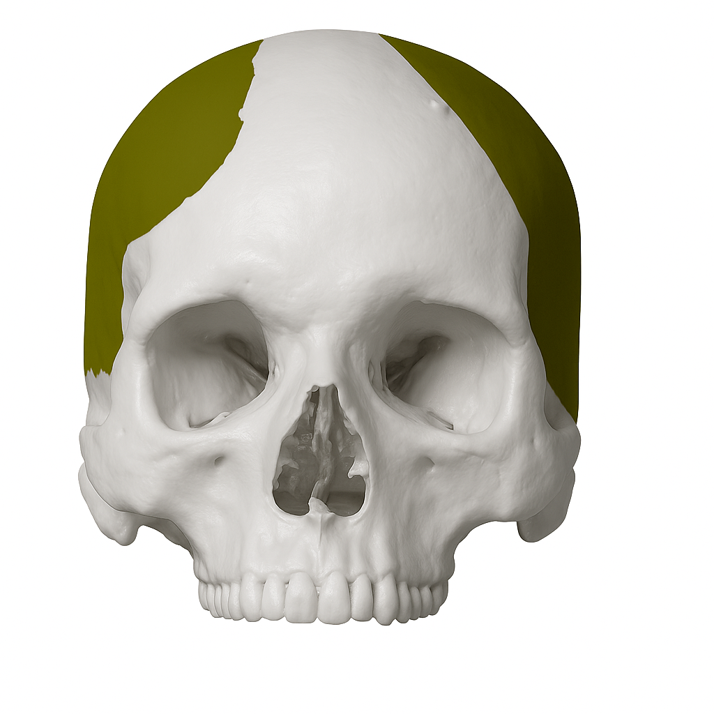 Implante craneal