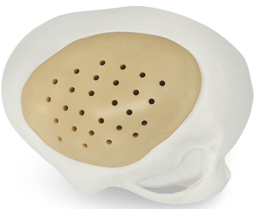 Implante craneal