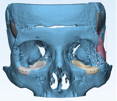 Caso maxilofacial 6